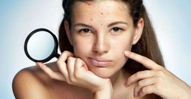 Acne onder de loep