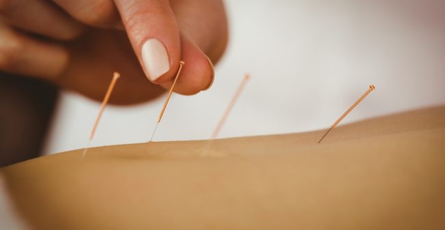 Acupunctuur bij darmklachten