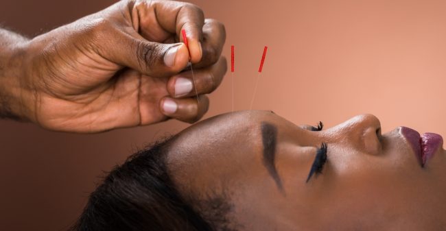 Acupunctuur bij spanningsklachten