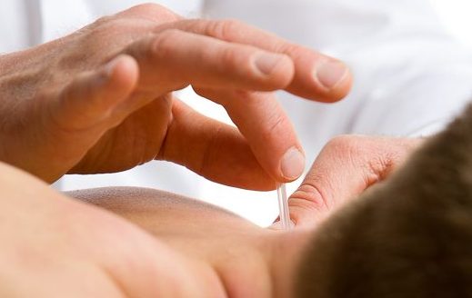 Dry needling: nieuwe methode tegen pijn