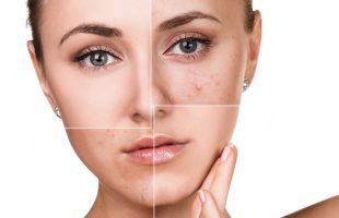 Acne: wat kun je eraan doen?