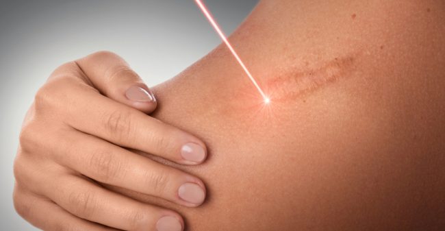 Behandelingen met laser: de ins & outs