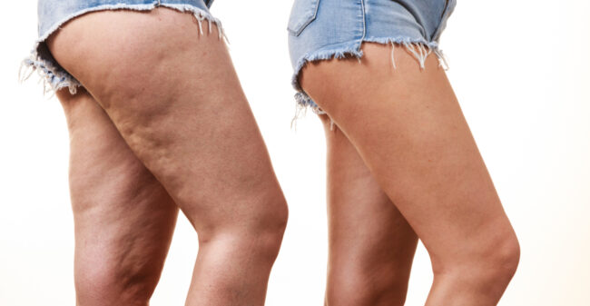 Vaarwel sinaasappelhuid!