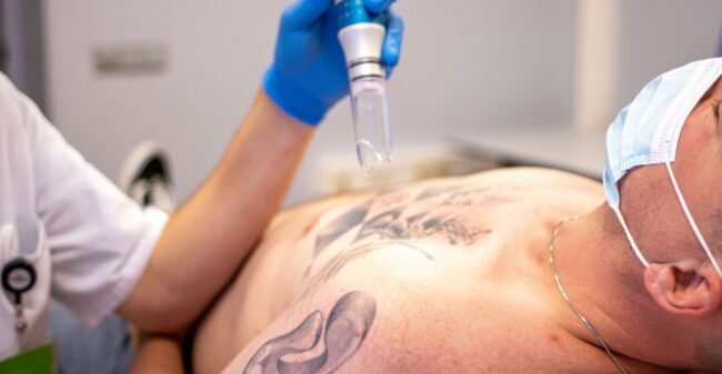 Tattoo verwijderen? Dit moet je weten