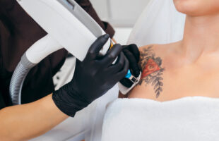 Ontevreden over je tattoo? Dit zijn de 6 dingen die je kunt doen