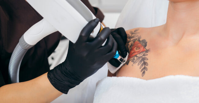 Ontevreden over je tattoo? Dit kun je doen